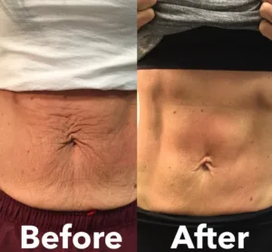abdomen before and after.jpg